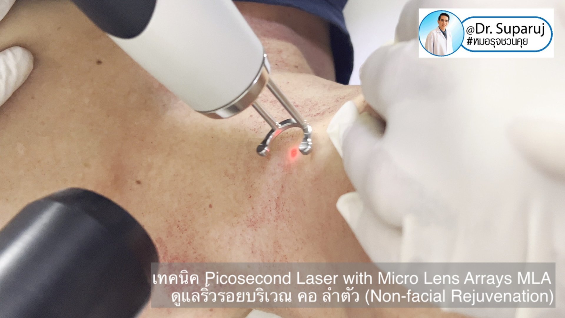 แนะนำ เทคนิคการใช้เลเซอร์ Picosecond Laser with Micro Lens Arrays MLA เพื่อดูแลริ้วรอยบริเวณ คอ ลำตัว (Non-facial rejuvenation) แนะนำ เทคนิคการใช้เลเซอร์ Picosecond Laser with Micro Lens Arrays MLA เพื่อดูแลริ้วรอยบริเวณ คอ ลำตัว (Non-facial rejuvenation)