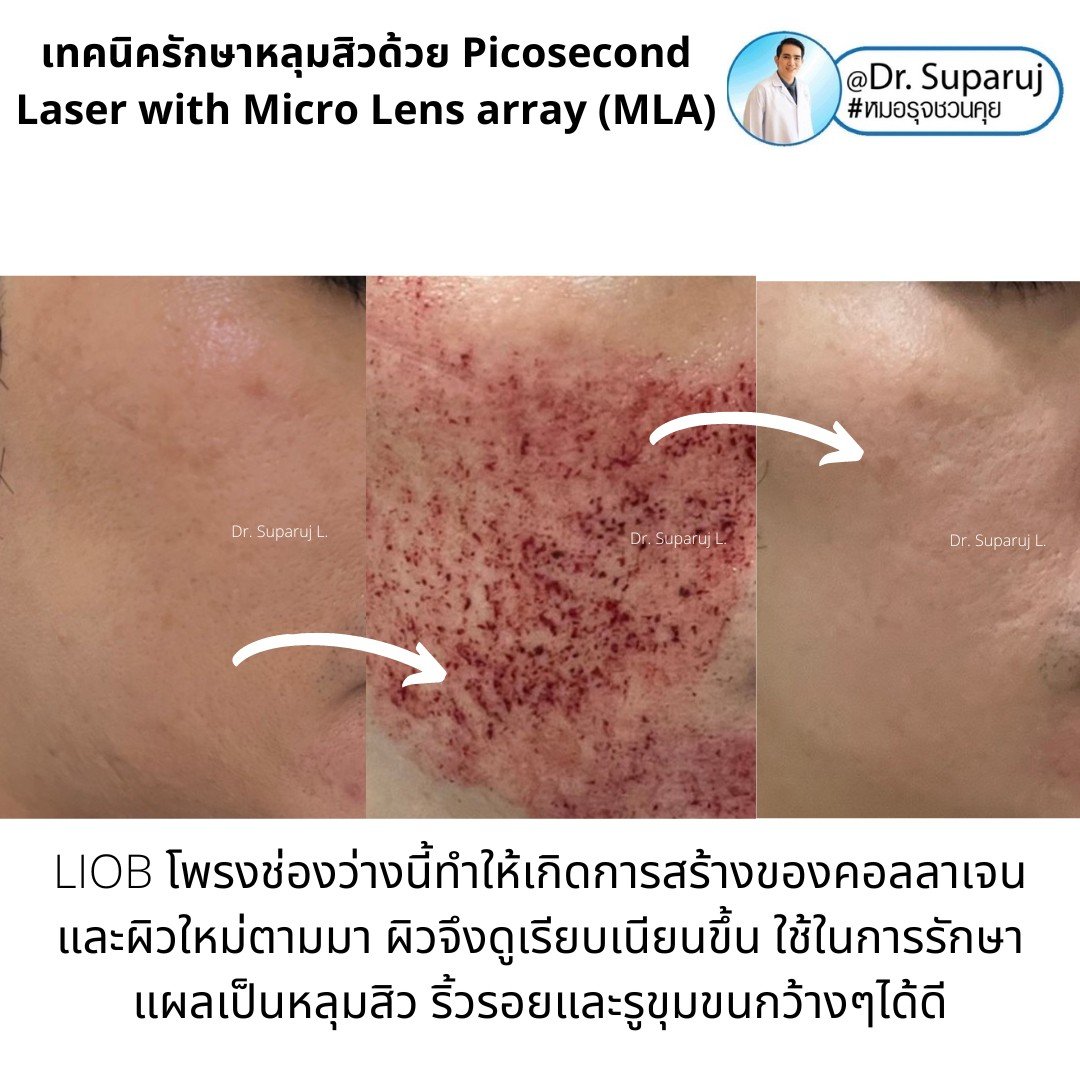 แนะนำเทคนิคดูแลหลุมสิว: Picosecond Laser แต่ละ Mode แตกต่างกันอย่างไร ?  ใช้ดูแลปัญหาไหน ชนิดไหนดีกว่ากัน: Full Beam/ Fractional MLA ?/ High Fluence/ Low Fluence