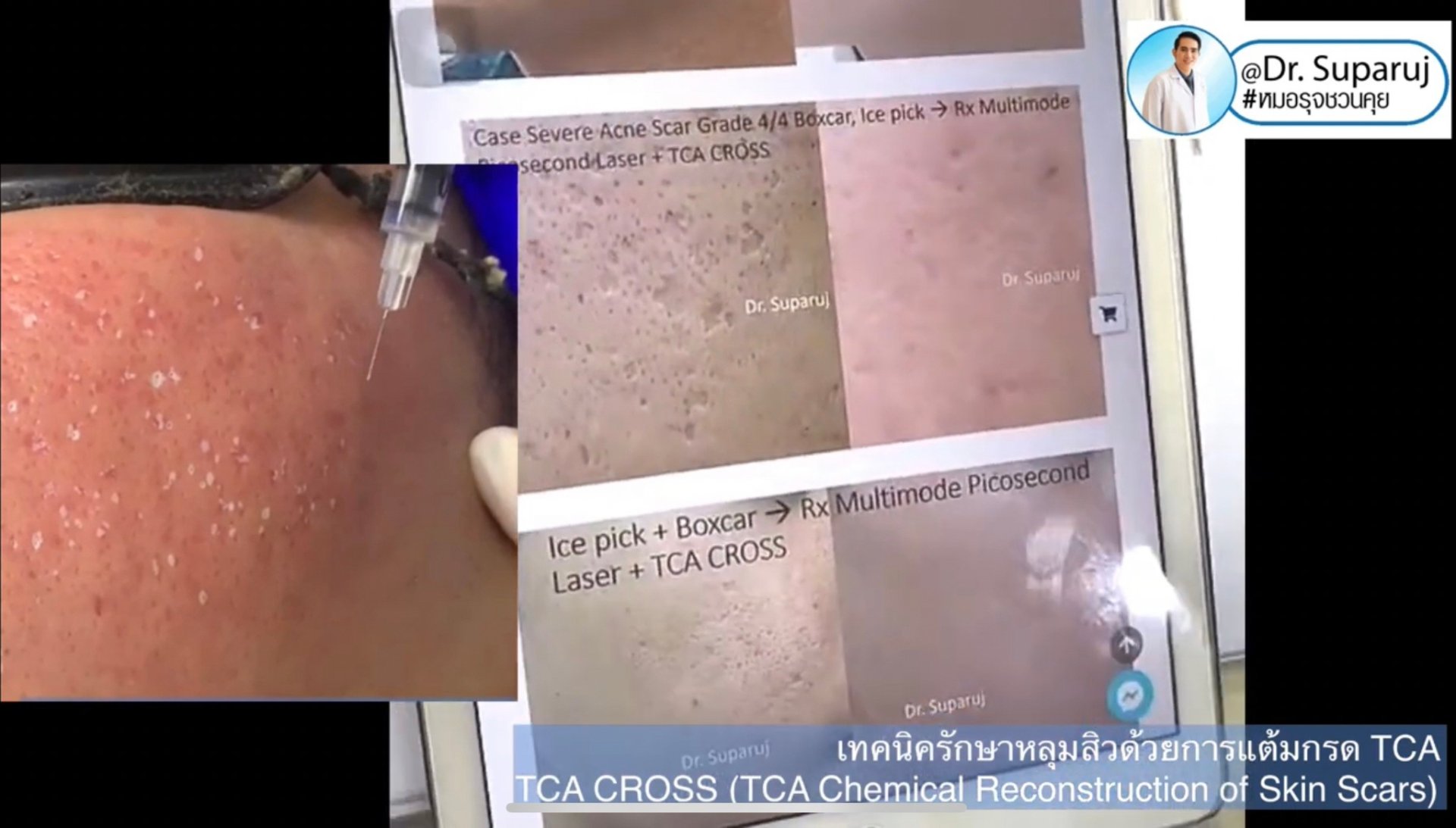 รักษาหลุมสิวด้วยการแต้มกรด TCA แล้วเกิดเป็นรอยดำ เกิดจากอะไรได้บ้าง? รักษาหลุมสิวด้วยการแต้มกรด TCA แล้วเกิดเป็นรอยดำ เกิดจากอะไรได้บ้าง?