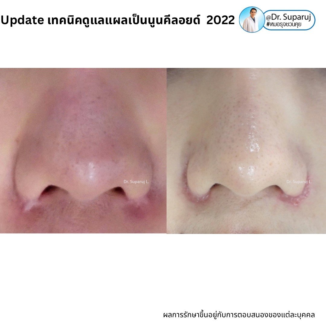 6 ปัจจัยที่ทำให้เกิดแผลเป็นนูนคีลอยด์ 6 ปัจจัยที่ทำให้เกิดแผลเป็นนูนคีลอยด์