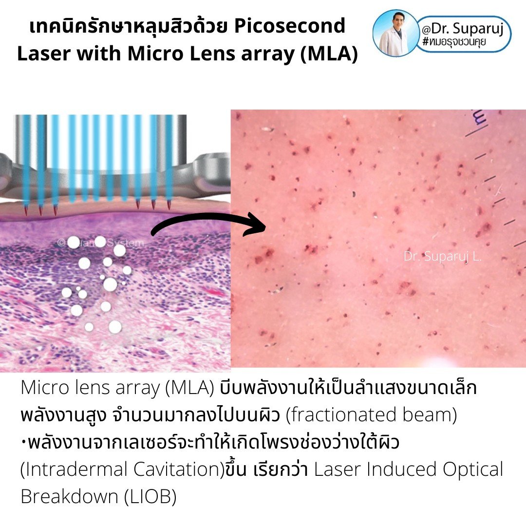 แนะนำเทคนิคดูแลหลุมสิว: Picosecond Laser แต่ละ Mode แตกต่างกันอย่างไร ? ใช้ดูแลปัญหาไหน ชนิดไหนดีกว่ากัน: Full Beam/ Fractional MLA ?/ High Fluence/ Low Fluence แนะนำเทคนิคดูแลหลุมสิว: Picosecond Laser แต่ละ Mode แตกต่างกันอย่างไร ? ใช้ดูแลปัญหาไหน ชนิดไหนดีกว่ากัน: Full Beam/ Fractional MLA ?/ High Fluence/ Low Fluence
