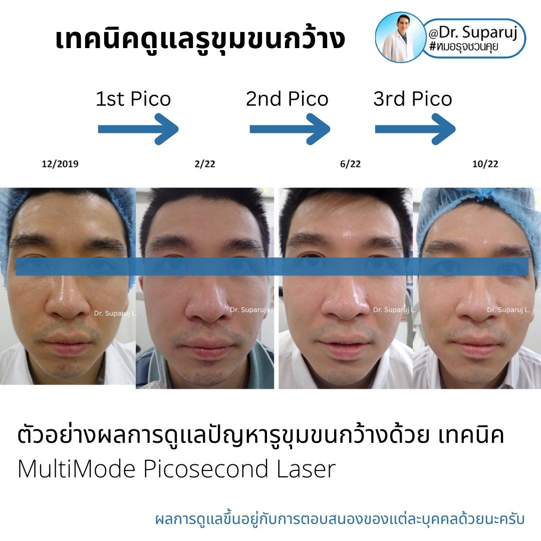แนะนำเทคนิคดูแลรูขุมขนกว้าง: ตัวอย่างผลการดูแลรูขุมขนกว้าง Enlarged Facial Pore ด้วย MultiMode Picosecond Laser แนะนำเทคนิคดูแลรูขุมขนกว้าง: ตัวอย่างผลการดูแลรูขุมขนกว้าง Enlarged Facial Pore ด้วย MultiMode Picosecond Laser