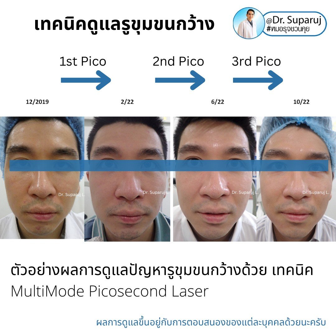 แนะนำเทคนิคดูแลรูขุมขนกว้าง: ตัวอย่างผลการดูแลรูขุมขนกว้าง Enlarged Facial Pore ด้วย MultiMode Picosecond Laser