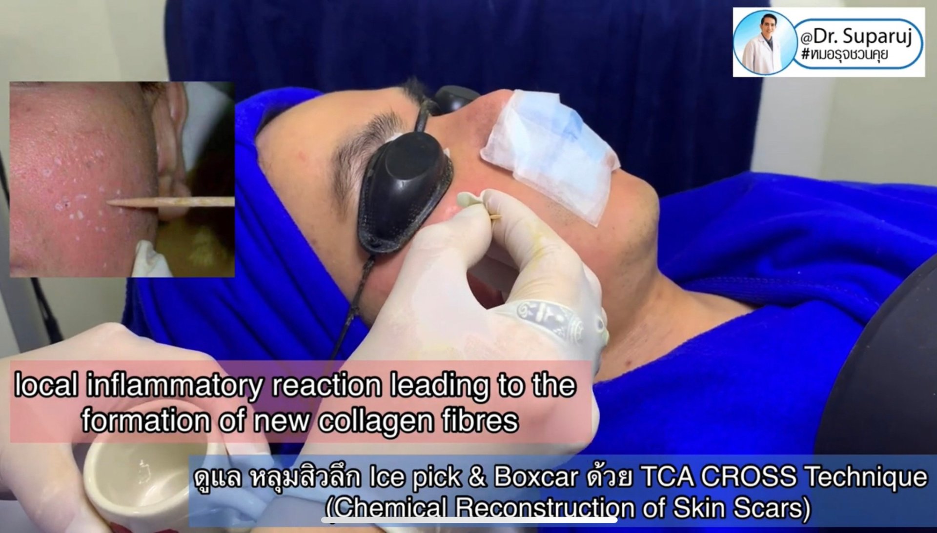 รักษาหลุมสิวด้วยการแต้มกรด TCA แล้วเกิดเป็นรอยดำ เกิดจากอะไรได้บ้าง? รักษาหลุมสิวด้วยการแต้มกรด TCA แล้วเกิดเป็นรอยดำ เกิดจากอะไรได้บ้าง?