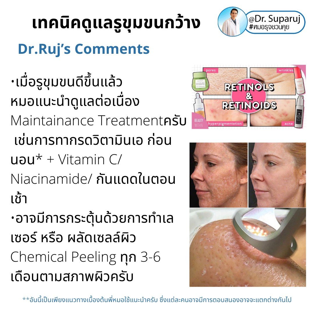 เทคนิควิเคราะห์ & รักษาขุมขนกว้าง Enlarged Facial Pore ด้วยกล้อส่องขยายพิเศษทางผิวหนัง Dermoscopy เทคนิควิเคราะห์ & รักษาขุมขนกว้าง Enlarged Facial Pore ด้วยกล้อส่องขยายพิเศษทางผิวหนัง Dermoscopy