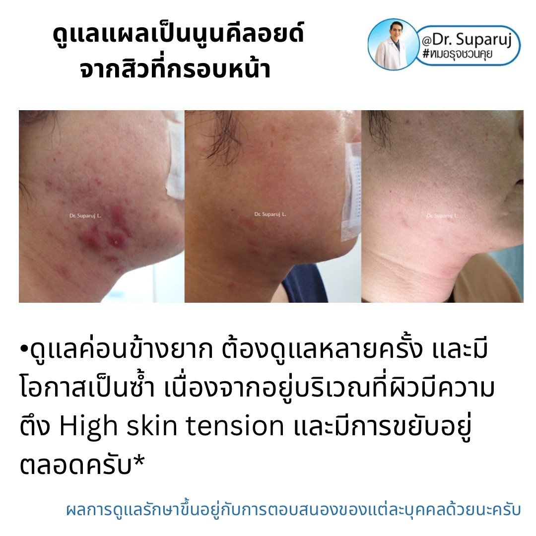 แนะนำเทคนิคดูแลแผลเป็นนูนคีลอยด์จากสิวที่กรอบหน้า MultiLaser Therapy and Injection Technique to Treat Keloid Acne Scar on Jawline แนะนำเทคนิคดูแลแผลเป็นนูนคีลอยด์จากสิวที่กรอบหน้า MultiLaser Therapy and Injection Technique to Treat Keloid Acne Scar on Jawline