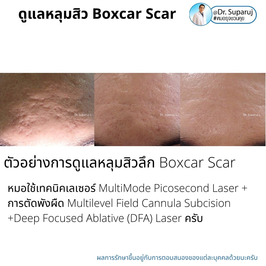 เทคนิคการดูแลหลุมสิว: ตัวอย่างการดูแลหลุมสิวแบบขอบชัดและแบบยุบตัวด้วยการใช้ Picosecond Laser + Perfusion Matrix Therapy เทคนิคการดูแลหลุมสิว: ตัวอย่างการดูแลหลุมสิวแบบขอบชัดและแบบยุบตัวด้วยการใช้ Picosecond Laser + Perfusion Matrix Therapy