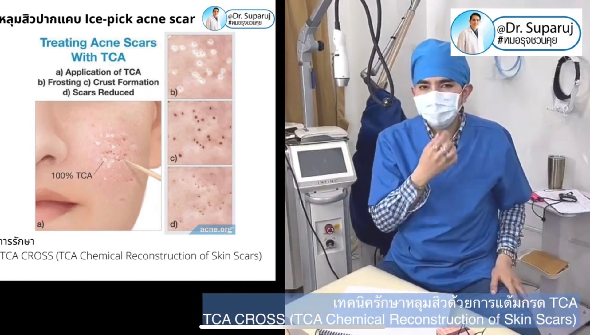 รักษาหลุมสิวด้วยการแต้มกรด TCA แล้วเกิดเป็นรอยดำ เกิดจากอะไรได้บ้าง? รักษาหลุมสิวด้วยการแต้มกรด TCA แล้วเกิดเป็นรอยดำ เกิดจากอะไรได้บ้าง?