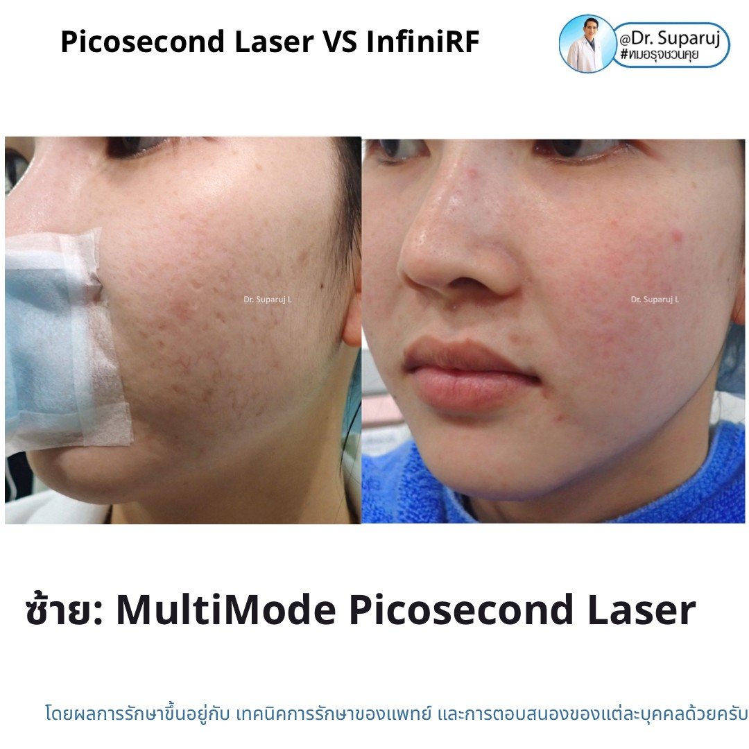 Update ผลการรักษาหลุมสิวด้วย Picosecond Laser VS InfiniRF Microneedle แตกต่างกันอย่างไร อันไหนมีประสิทธิภาพดีกว่า ? Update ผลการรักษาหลุมสิวด้วย Picosecond Laser VS InfiniRF Microneedle แตกต่างกันอย่างไร อันไหนมีประสิทธิภาพดีกว่า ?