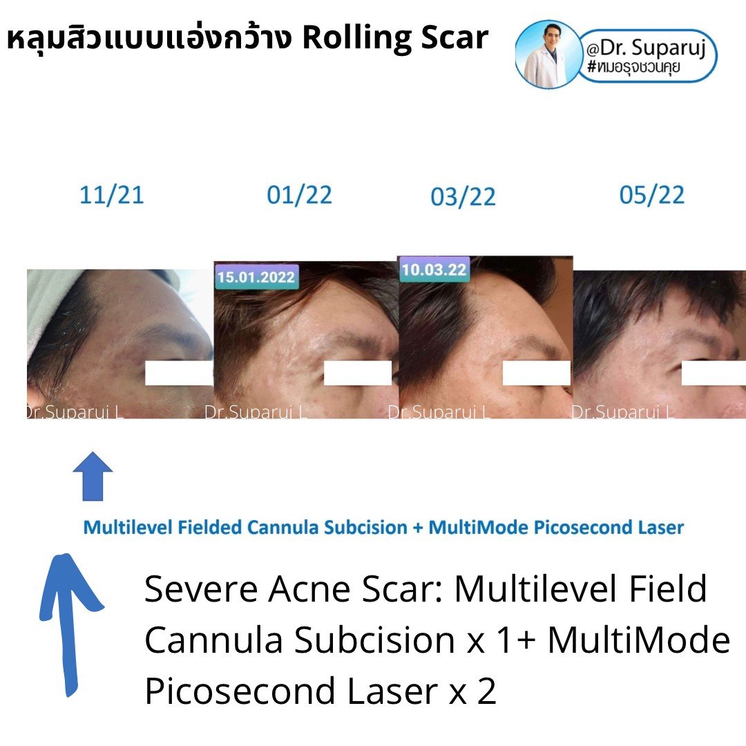 รักษาหลุมสิว ดูผลการรักษา ที่ระยะเวลาเท่าไหร่ดีที่สุด ? รักษาหลุมสิว ดูผลการรักษา ที่ระยะเวลาเท่าไหร่ดีที่สุด ?