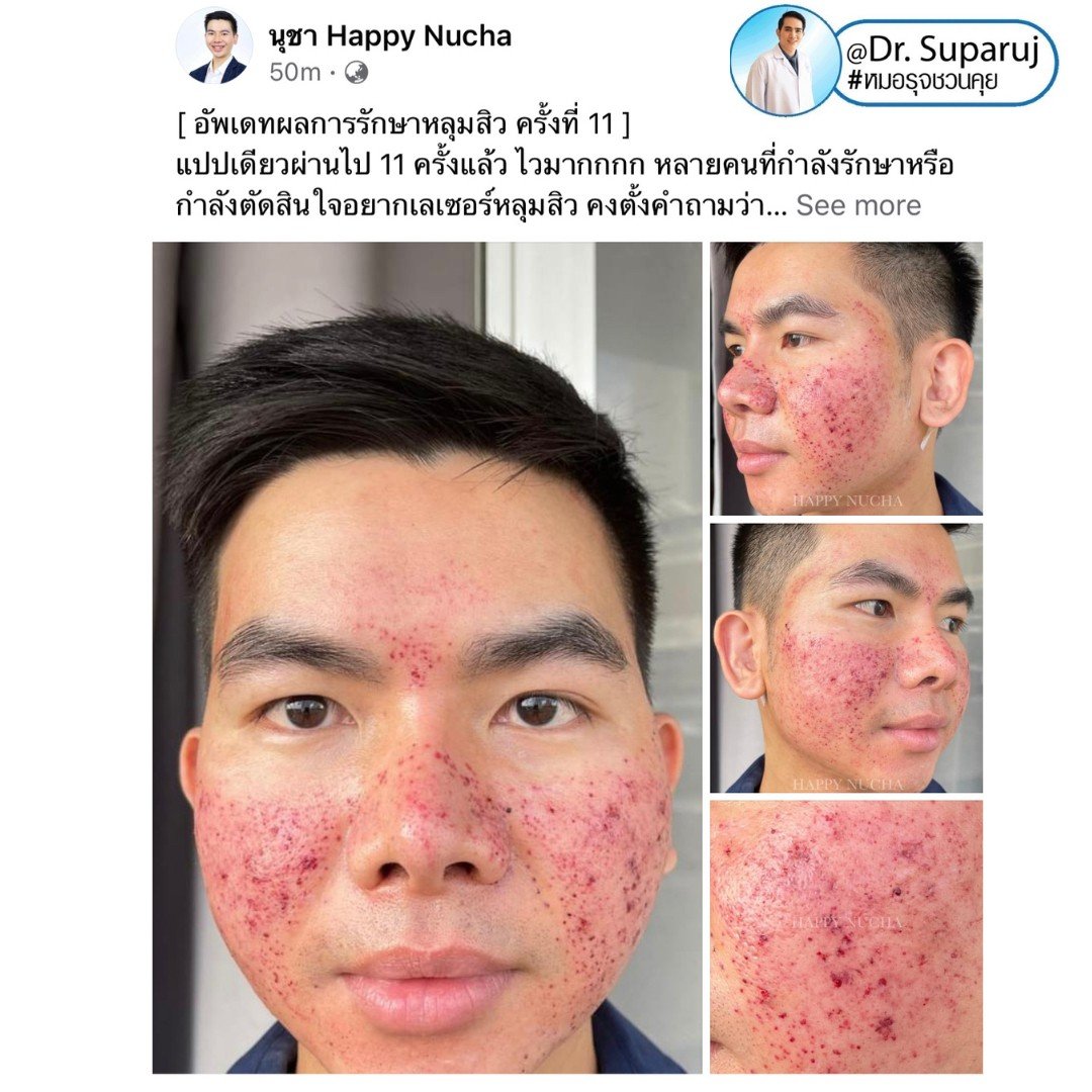 แนะนำเทคนิคดูแลหลุมสิว: Picosecond Laser แต่ละ Mode แตกต่างกันอย่างไร ? ใช้ดูแลปัญหาไหน ชนิดไหนดีกว่ากัน: Full Beam/ Fractional MLA ?/ High Fluence/ Low Fluence แนะนำเทคนิคดูแลหลุมสิว: Picosecond Laser แต่ละ Mode แตกต่างกันอย่างไร ? ใช้ดูแลปัญหาไหน ชนิดไหนดีกว่ากัน: Full Beam/ Fractional MLA ?/ High Fluence/ Low Fluence