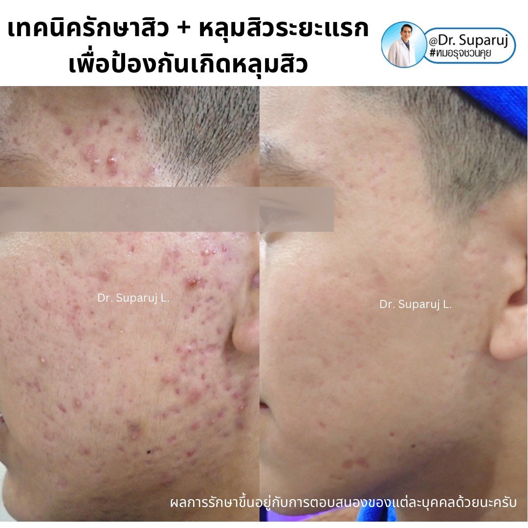 แนะนำเทคนิคการล้างหน้าตามแนวรูขุมขน/ โพรงขน เพื่อช่วยลดสิว รูขุมขนอักเสบ แนะนำเทคนิคการล้างหน้าตามแนวรูขุมขน/ โพรงขน เพื่อช่วยลดสิว รูขุมขนอักเสบ
