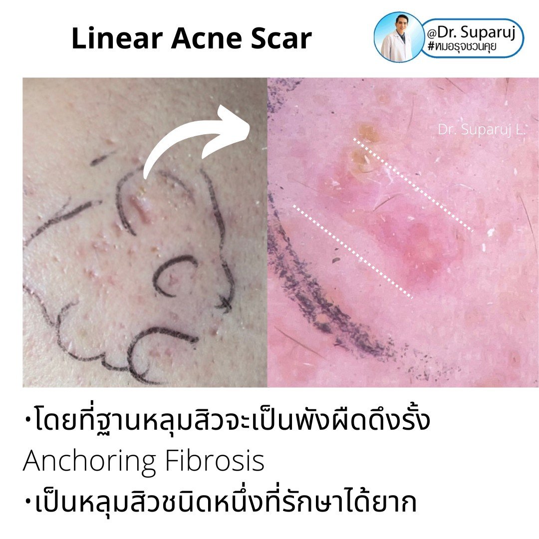  เทคนิคประเมินความรุนแรงพังผืดหลุมสิว Acne Scar Fibrosis Assessment : เทคนิคดึงยืดผิว Mannual Strechching (ง่ายๆ ประเมินได้ด้วยตัวเองครับ )