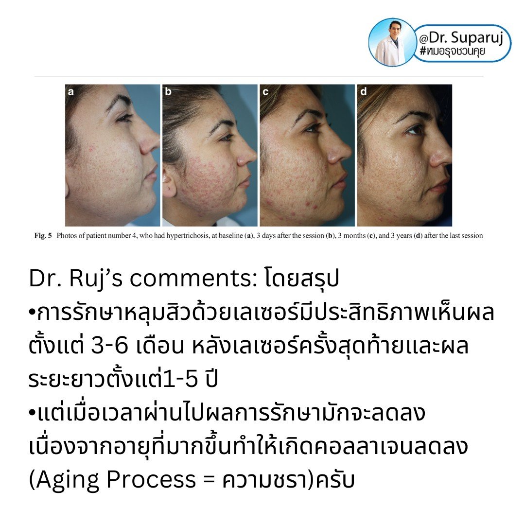 Q: หลังรักษาหลุมสิวด้วยเลเซอร์หรือเทคนิคต่างๆ หลังจากรักษาเรียบร้อยแล้ว จะมีโอกาสกลับมายุบตัว หรือหลุมสิวจะกลับมาแบบเดิมไหม? Q: หลังรักษาหลุมสิวด้วยเลเซอร์หรือเทคนิคต่างๆ หลังจากรักษาเรียบร้อยแล้ว จะมีโอกาสกลับมายุบตัว หรือหลุมสิวจะกลับมาแบบเดิมไหม?