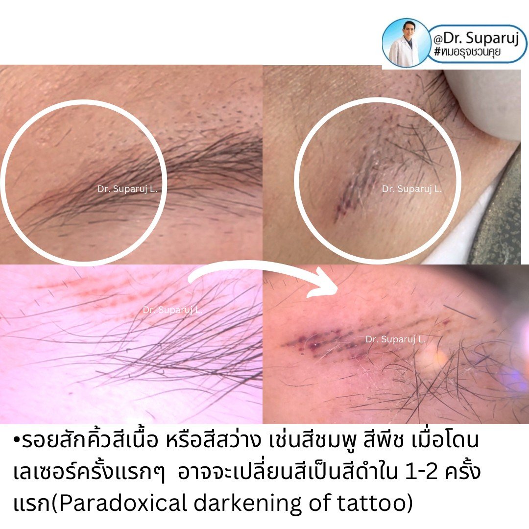 เทคนิคลบรอยสักคิ้ว ด้วยเลเซอร์ Picosecond Laser และลบรอยสักสีเนื้อต้องระวังอะไรบ้าง ?