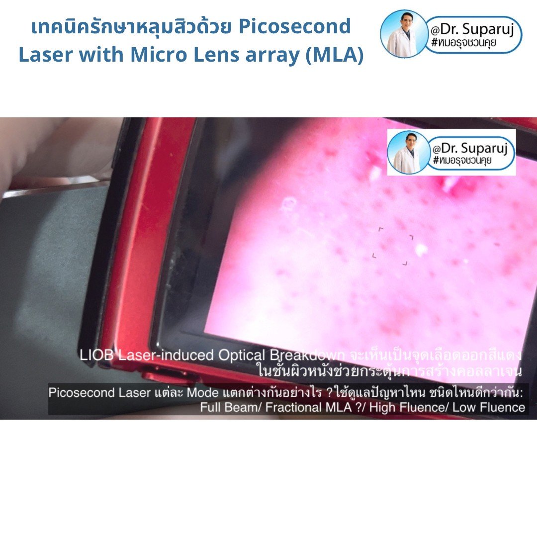 แนะนำเทคนิคดูแลหลุมสิว: Picosecond Laser แต่ละ Mode แตกต่างกันอย่างไร ?  ใช้ดูแลปัญหาไหน ชนิดไหนดีกว่ากัน: Full Beam/ Fractional MLA ?/ High Fluence/ Low Fluence