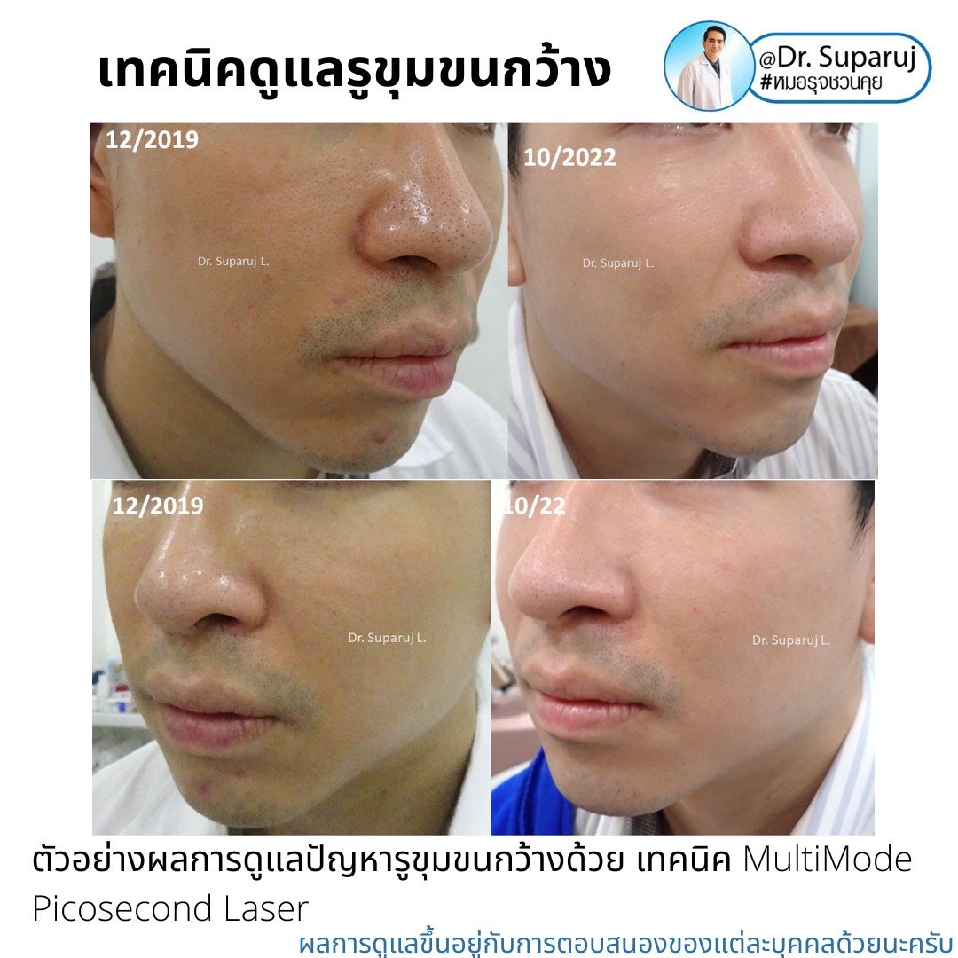 แนะนำเทคนิคดูแลรูขุมขนกว้าง: ตัวอย่างผลการดูแลรูขุมขนกว้าง Enlarged Facial Pore ด้วย MultiMode Picosecond Laser แนะนำเทคนิคดูแลรูขุมขนกว้าง: ตัวอย่างผลการดูแลรูขุมขนกว้าง Enlarged Facial Pore ด้วย MultiMode Picosecond Laser