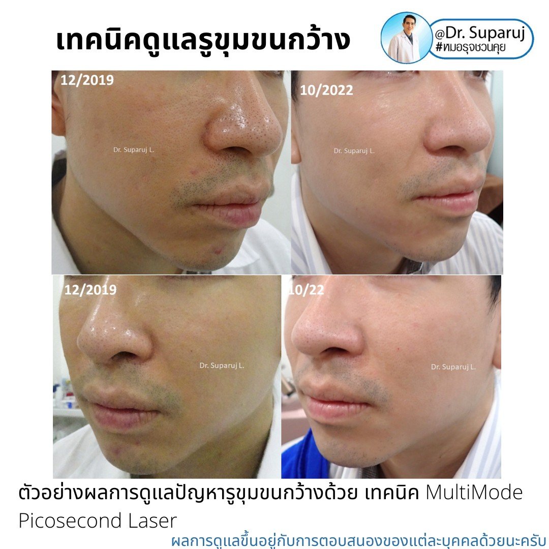 แนะนำเทคนิคดูแลรูขุมขนกว้าง: ตัวอย่างผลการดูแลรูขุมขนกว้าง Enlarged Facial Pore ด้วย MultiMode Picosecond Laser