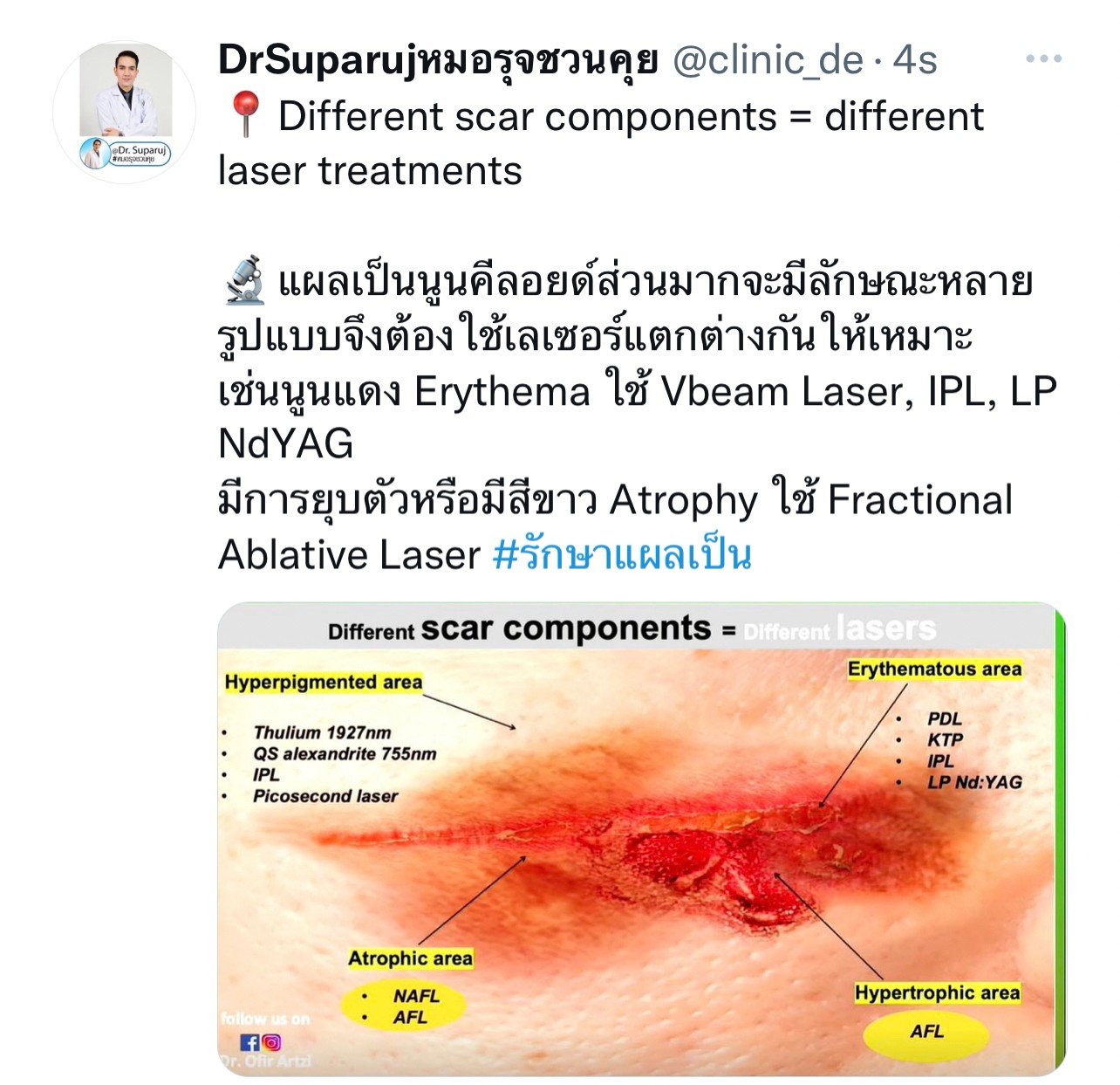 แผลเป็นนูนคีลอยคีลอยด์สามารถรักษาด้วยโดยวิธีผ่าตัดออกได้ไหม ? แผลเป็นนูนคีลอยคีลอยด์สามารถรักษาด้วยโดยวิธีผ่าตัดออกได้ไหม ?