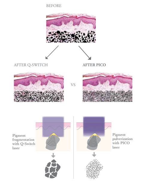 เทคนิคดูแลริ้วรอย ด้วย Picosecond Laser with Micro Lens array (MLA) มีกลไกล & จุดเด่นอย่างไร?