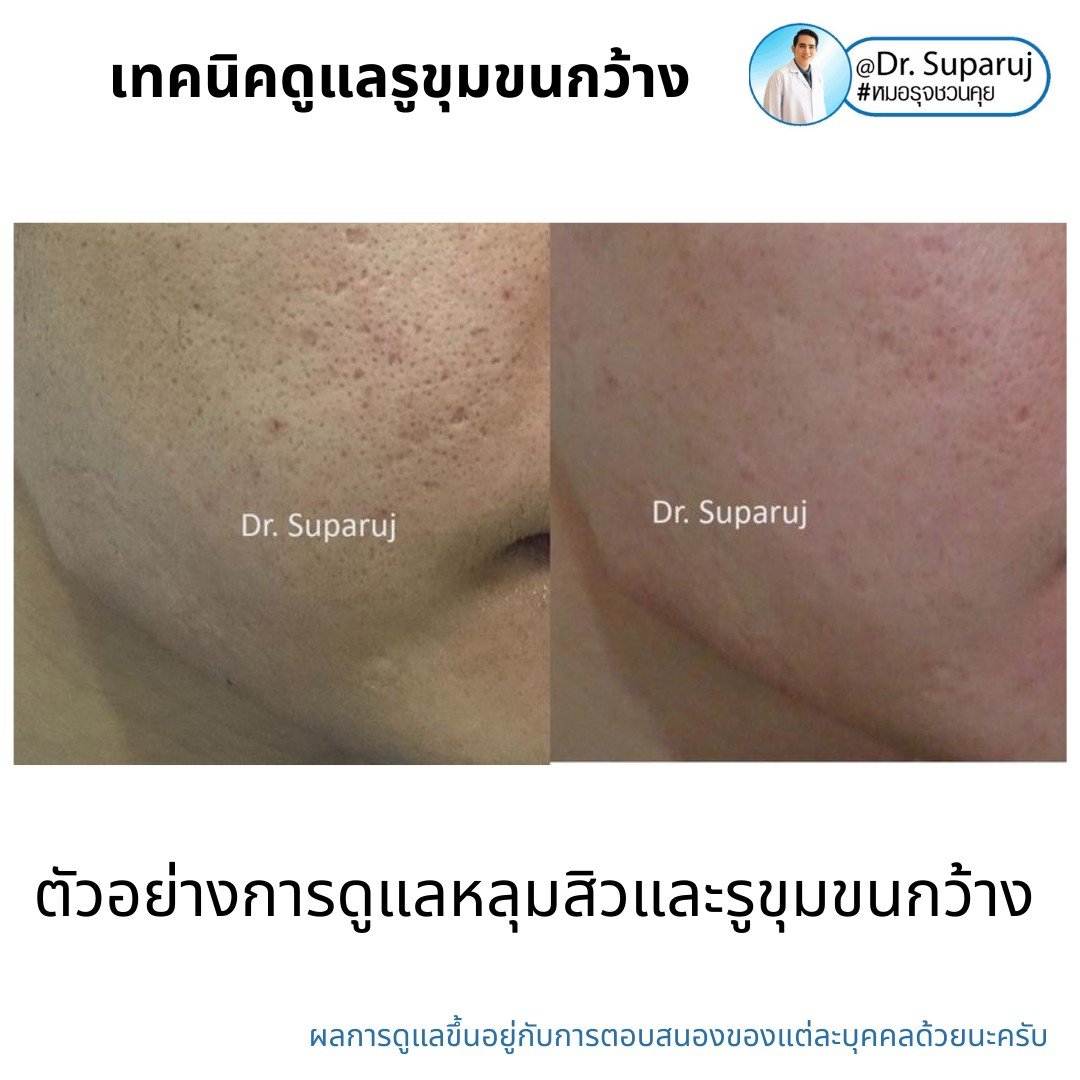 เทคนิควิเคราะห์ & รักษาขุมขนกว้าง Enlarged Facial Pore ด้วยกล้อส่องขยายพิเศษทางผิวหนัง Dermoscopy