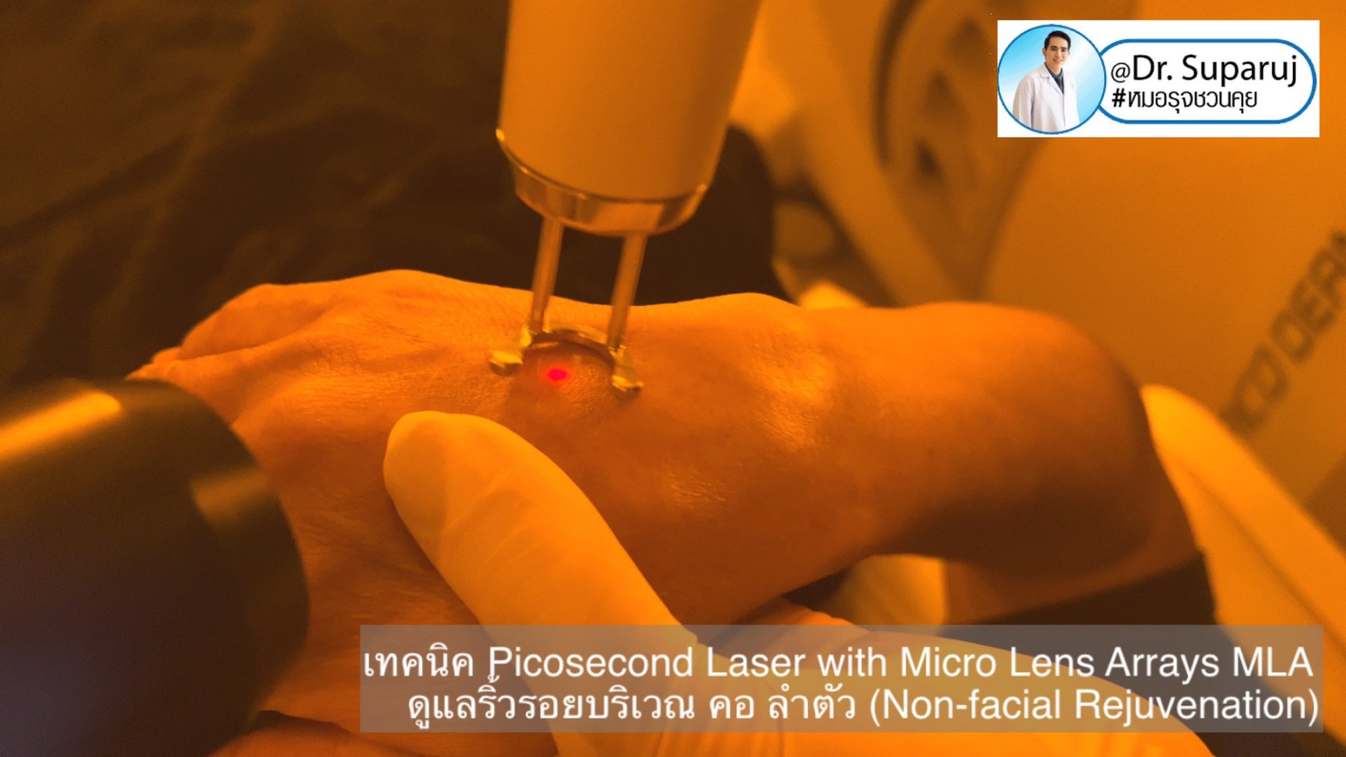 แนะนำ เทคนิคการใช้เลเซอร์ Picosecond Laser with Micro Lens Arrays MLA เพื่อดูแลริ้วรอยบริเวณ คอ ลำตัว (Non-facial rejuvenation) แนะนำ เทคนิคการใช้เลเซอร์ Picosecond Laser with Micro Lens Arrays MLA เพื่อดูแลริ้วรอยบริเวณ คอ ลำตัว (Non-facial rejuvenation)