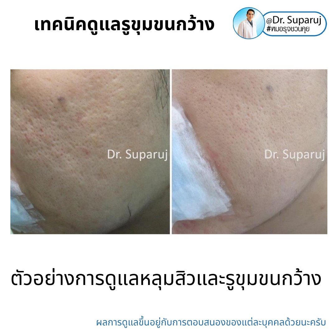 เทคนิควิเคราะห์ & รักษาขุมขนกว้าง Enlarged Facial Pore ด้วยกล้อส่องขยายพิเศษทางผิวหนัง Dermoscopy