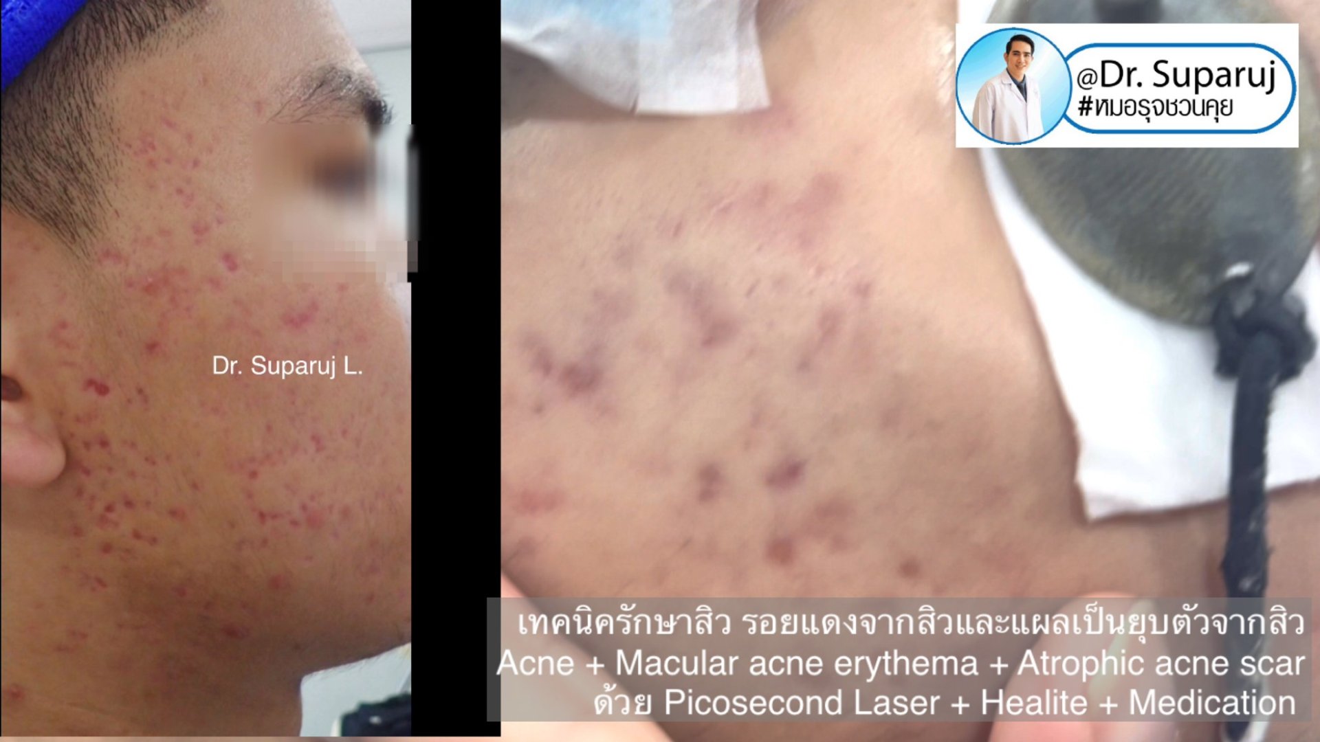 แนะนำเทคนิคดูแลรักษาสิวและหลุมสิว: ดูแลรอยแดงจากสิวและแผลเป็นยุบตัวจากสิว Acne + Macular acne erythema + Atrophic acne scar ดูแลด้วย Picosecond Laser + Healite + Medication แนะนำเทคนิคดูแลรักษาสิวและหลุมสิว: ดูแลรอยแดงจากสิวและแผลเป็นยุบตัวจากสิว Acne + Macular acne erythema + Atrophic acne scar ดูแลด้วย Picosecond Laser + Healite + Medication