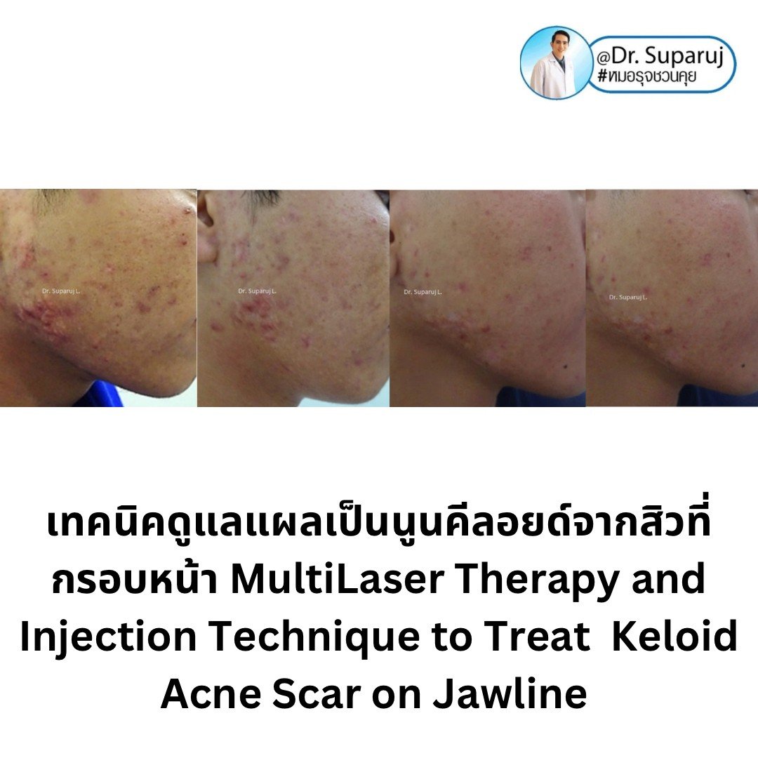  แนะนำเทคนิคดูแลแผลเป็นนูนคีลอยด์จากสิวที่กรอบหน้า MultiLaser Therapy and Injection Technique to Treat Keloid Acne Scar on Jawline