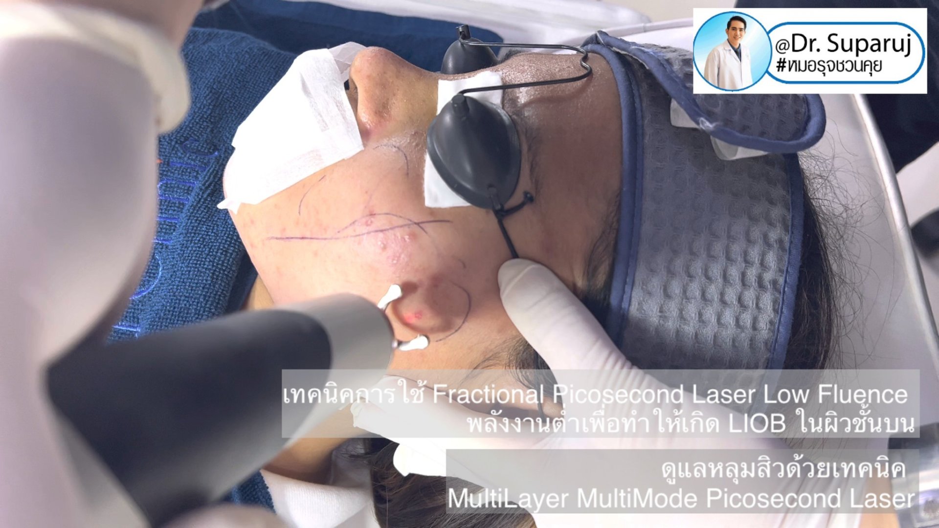 เทคนิครักษาหลุมสิวด้วยเลเซอร์ MultiLayer MultiMode Picosecond Laser เทคนิครักษาหลุมสิวด้วยเลเซอร์ MultiLayer MultiMode Picosecond Laser