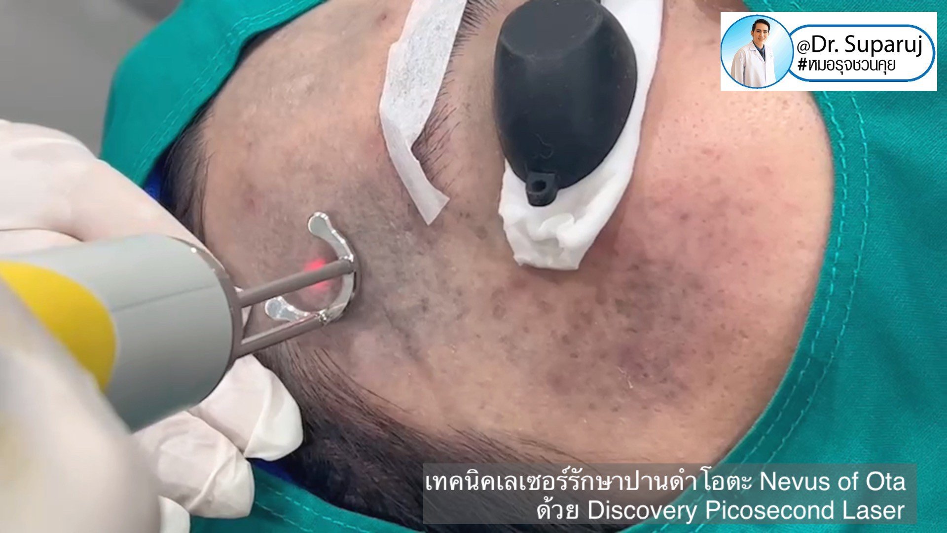 เทคนิคเลเซอร์รักษาปานดำโอตะ Nevus of Ota ด้วย Discovery Picosecond Laser เลเซอร์ปานดำ l หมอรุจชวนคุย เทคนิคเลเซอร์รักษาปานดำโอตะ Nevus of Ota ด้วย Discovery Picosecond Laser เลเซอร์ปานดำ l หมอรุจชวนคุย