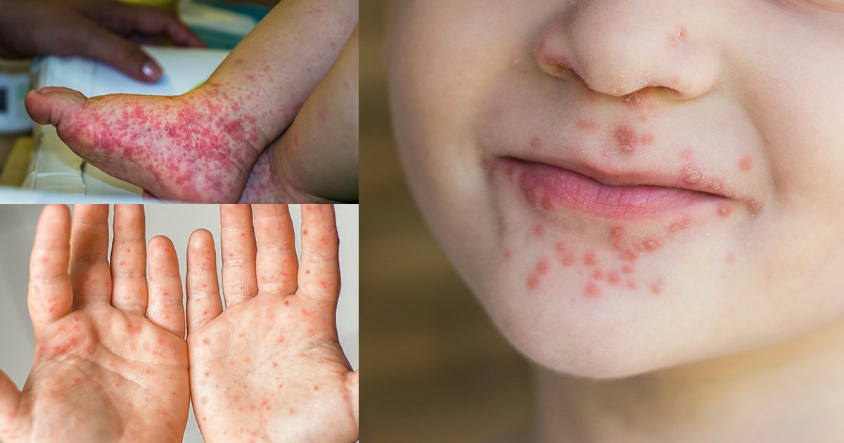 มือ เท้า ปาก โรคที่ควรระวังช่วงหน้าฝน มือ เท้า ปาก โรคที่ควรระวังช่วงหน้าฝน