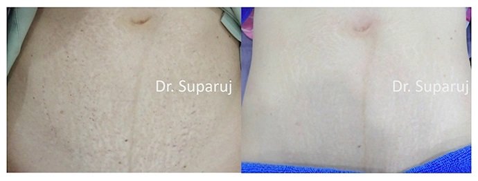 รักษาผิวแตกลายด้วยเทคนิคเลเซอร์ Double Laser Treatment : Picosecond Laser + Fractional Ablative Laser รักษาผิวแตกลายด้วยเทคนิคเลเซอร์ Double Laser Treatment : Picosecond Laser + Fractional Ablative Laser