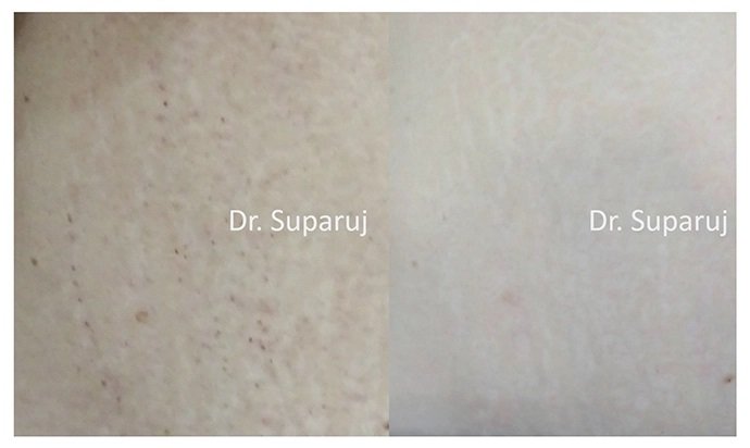 รักษาผิวแตกลายด้วยเทคนิคเลเซอร์ Double Laser Treatment : Picosecond Laser + Fractional Ablative Laser รักษาผิวแตกลายด้วยเทคนิคเลเซอร์ Double Laser Treatment : Picosecond Laser + Fractional Ablative Laser
