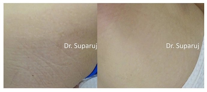 รักษาผิวแตกลายด้วยเทคนิคเลเซอร์ Double Laser Treatment : Picosecond Laser + Fractional Ablative Laser รักษาผิวแตกลายด้วยเทคนิคเลเซอร์ Double Laser Treatment : Picosecond Laser + Fractional Ablative Laser