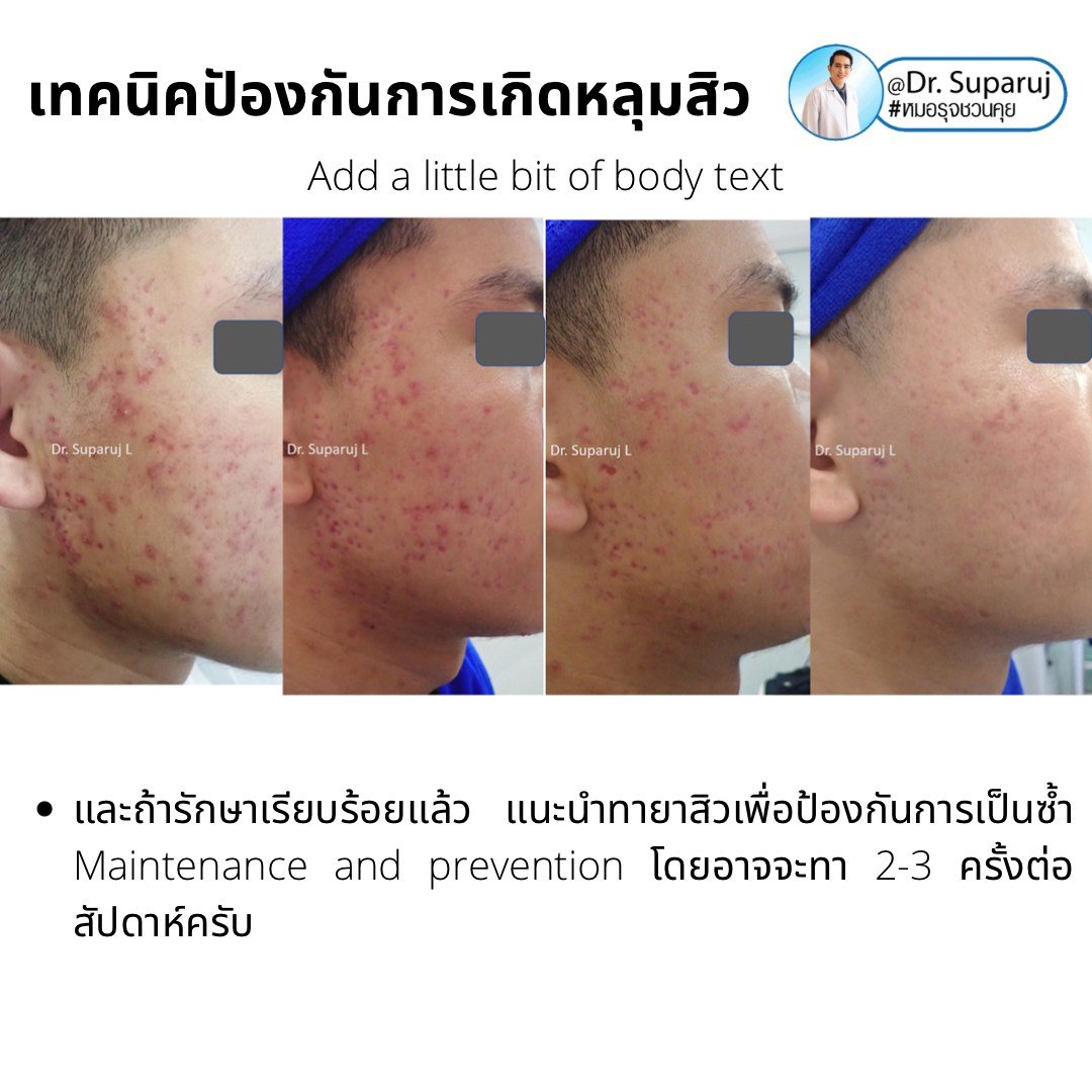 แนะนำเทคนิคทายารักษาสิว ง่ายๆทีละขั้นตอน Step-by-step ตาม Link นี้เลยครับ แนะนำเทคนิคทายารักษาสิว ง่ายๆทีละขั้นตอน Step-by-step ตาม Link นี้เลยครับ