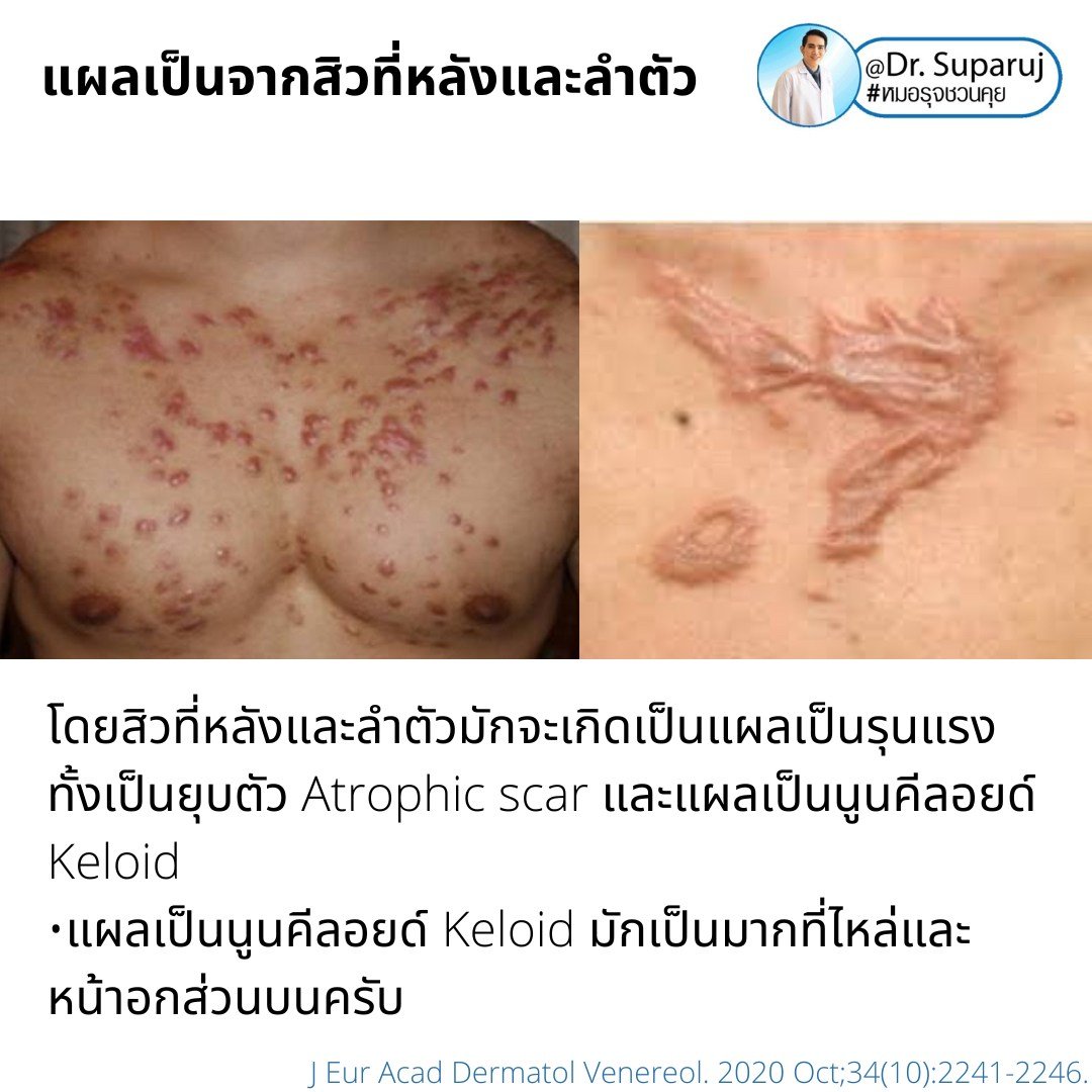 เทคนิครักษาสิวที่หลังและลำตัว Back ance and Truncal acne Treatment