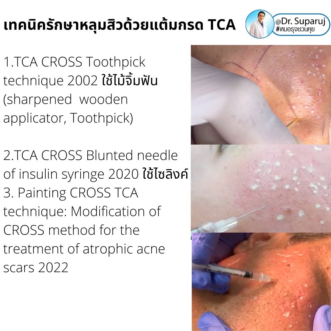 Update เทคนิครักษาหลุมสิวด้วยการแต้มกรด TCA: เทคนิคไม้จิ้มฟัน Toothpicks VS Syringe ไซริงค์ VS Painting CROSS TCA technique ต่างกันอย่างไร เทคนิคไหนดีที่สุด? https://youtu.be/CGeVtG64Elo Update เทคนิครักษาหลุมสิวด้วยการแต้มกรด TCA: เทคนิคไม้จิ้มฟัน Toothpicks VS Syringe ไซริงค์ VS Painting CROSS TCA technique ต่างกันอย่างไร เทคนิคไหนดีที่สุด? https://youtu.be/CGeVtG64Elo