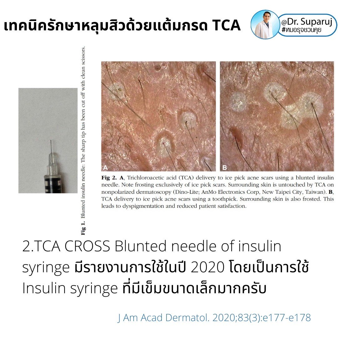 Update เทคนิครักษาหลุมสิวด้วยการแต้มกรด TCA: เทคนิคไม้จิ้มฟัน Toothpicks VS Syringe ไซริงค์ VS Painting CROSS TCA technique ต่างกันอย่างไร เทคนิคไหนดีที่สุด? https://youtu.be/CGeVtG64Elo Update เทคนิครักษาหลุมสิวด้วยการแต้มกรด TCA: เทคนิคไม้จิ้มฟัน Toothpicks VS Syringe ไซริงค์ VS Painting CROSS TCA technique ต่างกันอย่างไร เทคนิคไหนดีที่สุด? https://youtu.be/CGeVtG64Elo