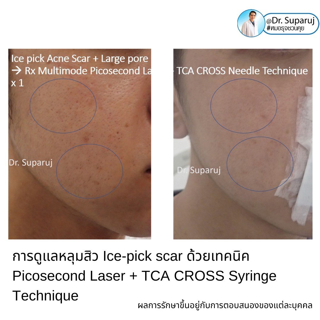 Update เทคนิครักษาหลุมสิวด้วยการแต้มกรด TCA: เทคนิคไม้จิ้มฟัน Toothpicks VS Syringe ไซริงค์ VS Painting CROSS TCA technique ต่างกันอย่างไร เทคนิคไหนดีที่สุด? https://youtu.be/CGeVtG64Elo