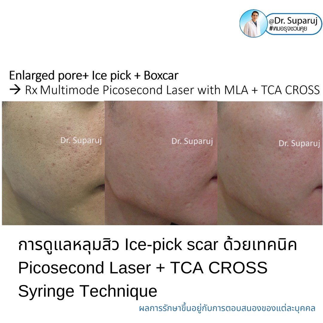 Update เทคนิครักษาหลุมสิวด้วยการแต้มกรด TCA: เทคนิคไม้จิ้มฟัน Toothpicks VS Syringe ไซริงค์ VS Painting CROSS TCA technique ต่างกันอย่างไร เทคนิคไหนดีที่สุด? https://youtu.be/CGeVtG64Elo Update เทคนิครักษาหลุมสิวด้วยการแต้มกรด TCA: เทคนิคไม้จิ้มฟัน Toothpicks VS Syringe ไซริงค์ VS Painting CROSS TCA technique ต่างกันอย่างไร เทคนิคไหนดีที่สุด? https://youtu.be/CGeVtG64Elo