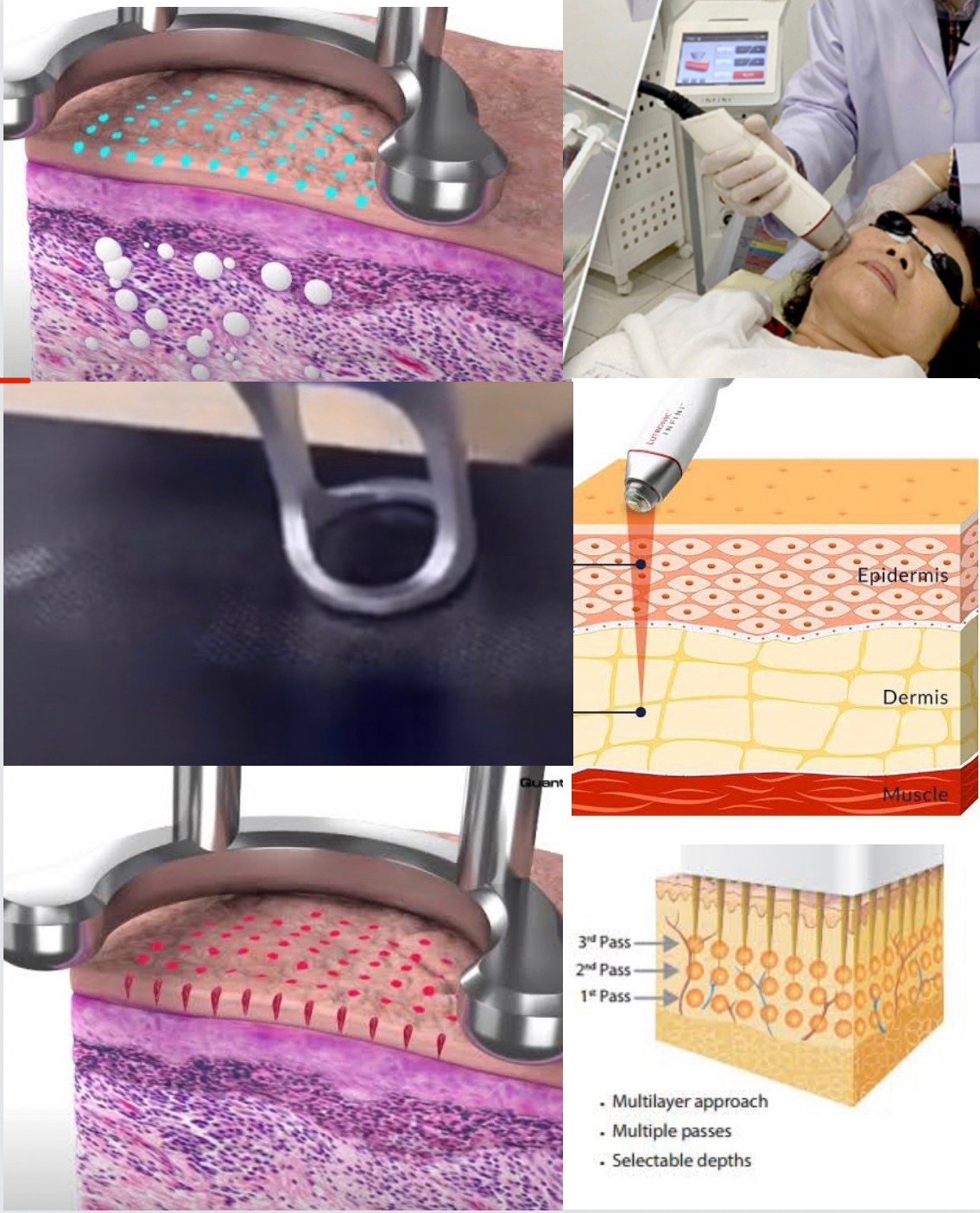 เทคนิครักษาหลุมสิวด้วย Picosecond Laser VS InfiniRF Microneedle แตกต่างกันอย่างไร อันไหนมีประสิทธิภาพดีกว่า ? เทคนิครักษาหลุมสิวด้วย Picosecond Laser VS InfiniRF Microneedle แตกต่างกันอย่างไร อันไหนมีประสิทธิภาพดีกว่า ?