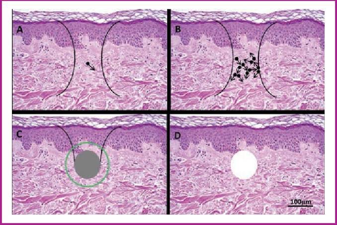 เทคนิครักษาหลุมสิวด้วย Picosecond Laser VS InfiniRF Microneedle แตกต่างกันอย่างไร อันไหนมีประสิทธิภาพดีกว่า ? เทคนิครักษาหลุมสิวด้วย Picosecond Laser VS InfiniRF Microneedle แตกต่างกันอย่างไร อันไหนมีประสิทธิภาพดีกว่า ?