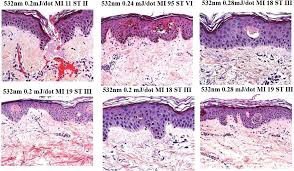 เทคนิครักษาหลุมสิวด้วย Picosecond Laser VS InfiniRF Microneedle แตกต่างกันอย่างไร อันไหนมีประสิทธิภาพดีกว่า ? เทคนิครักษาหลุมสิวด้วย Picosecond Laser VS InfiniRF Microneedle แตกต่างกันอย่างไร อันไหนมีประสิทธิภาพดีกว่า ?