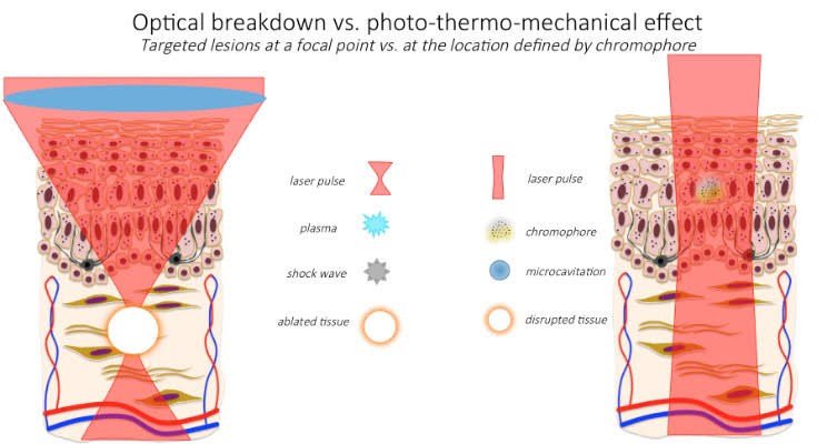เทคนิครักษาหลุมสิวด้วย Picosecond Laser VS InfiniRF Microneedle แตกต่างกันอย่างไร อันไหนมีประสิทธิภาพดีกว่า ? เทคนิครักษาหลุมสิวด้วย Picosecond Laser VS InfiniRF Microneedle แตกต่างกันอย่างไร อันไหนมีประสิทธิภาพดีกว่า ?