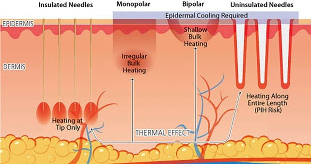 เทคนิครักษาหลุมสิวด้วย Picosecond Laser VS InfiniRF Microneedle แตกต่างกันอย่างไร อันไหนมีประสิทธิภาพดีกว่า ? เทคนิครักษาหลุมสิวด้วย Picosecond Laser VS InfiniRF Microneedle แตกต่างกันอย่างไร อันไหนมีประสิทธิภาพดีกว่า ?