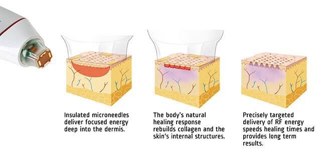 เทคนิครักษาหลุมสิวด้วย Picosecond Laser VS InfiniRF Microneedle แตกต่างกันอย่างไร อันไหนมีประสิทธิภาพดีกว่า ? เทคนิครักษาหลุมสิวด้วย Picosecond Laser VS InfiniRF Microneedle แตกต่างกันอย่างไร อันไหนมีประสิทธิภาพดีกว่า ?