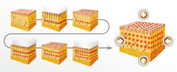 เทคนิครักษาหลุมสิวด้วย Picosecond Laser VS InfiniRF Microneedle แตกต่างกันอย่างไร อันไหนมีประสิทธิภาพดีกว่า ? เทคนิครักษาหลุมสิวด้วย Picosecond Laser VS InfiniRF Microneedle แตกต่างกันอย่างไร อันไหนมีประสิทธิภาพดีกว่า ?
