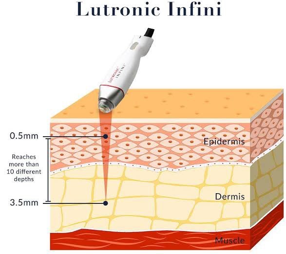 เทคนิครักษาหลุมสิวด้วย Picosecond Laser VS InfiniRF Microneedle แตกต่างกันอย่างไร อันไหนมีประสิทธิภาพดีกว่า ? เทคนิครักษาหลุมสิวด้วย Picosecond Laser VS InfiniRF Microneedle แตกต่างกันอย่างไร อันไหนมีประสิทธิภาพดีกว่า ?
