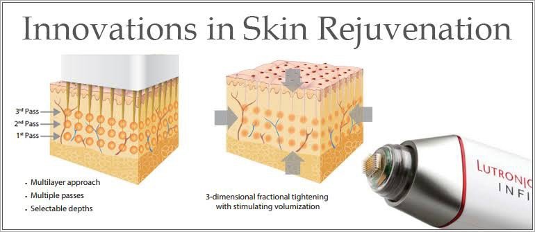 เทคนิครักษาหลุมสิวด้วย Picosecond Laser VS InfiniRF Microneedle แตกต่างกันอย่างไร อันไหนมีประสิทธิภาพดีกว่า ?